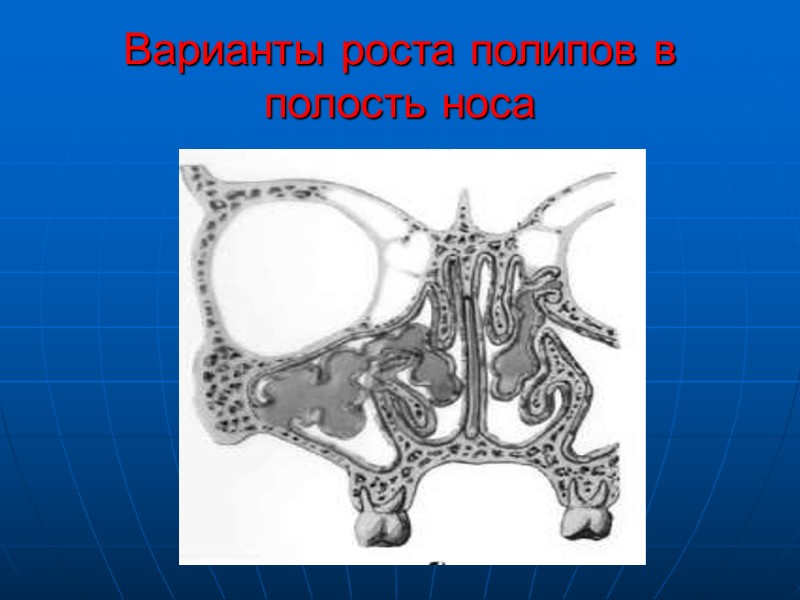 Варианты роста полипов в полость носа